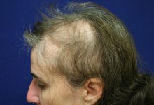 Doctors Donate Reconstructive Hair Surgery to Veteran